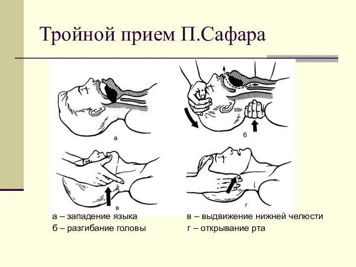 Тройной прием П.Сафара а – западение языка в – выдвижение нижней