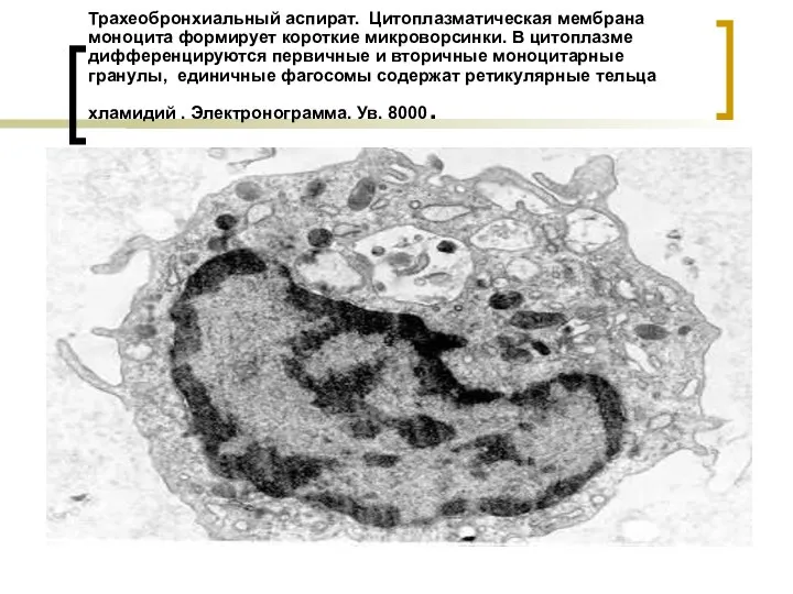 Трахеобронхиальный аспират. Цитоплазматическая мембрана моноцита формирует короткие микроворсинки. В цитоплазме дифференцируются