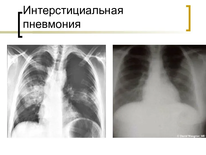 Интерстициальная пневмония