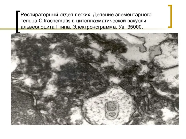 Респираторный отдел легких. Деление элементарного тельца С.trachomatis в цитоплазматической вакуоли альвеолоцита I типа. Электронограмма. Ув. 35000.