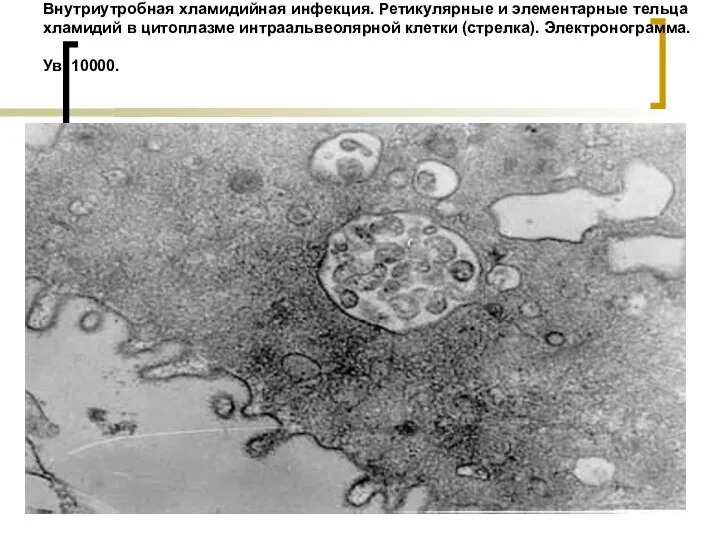 Внутриутробная хламидийная инфекция. Ретикулярные и элементарные тельца хламидий в цитоплазме интраальвеолярной клетки (стрелка). Электронограмма. Ув. 10000.