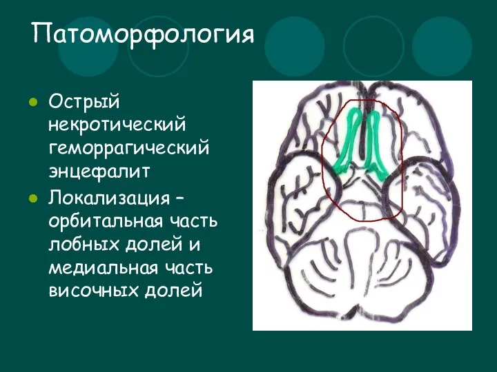 Патоморфология Острый некротический геморрагический энцефалит Локализация – орбитальная часть лобных долей и медиальная часть височных долей