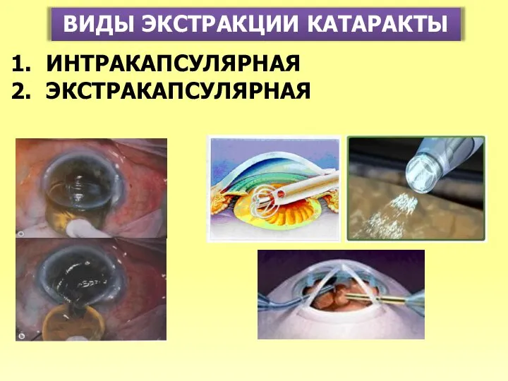 ВИДЫ ЭКСТРАКЦИИ КАТАРАКТЫ ИНТРАКАПСУЛЯРНАЯ ЭКСТРАКАПСУЛЯРНАЯ