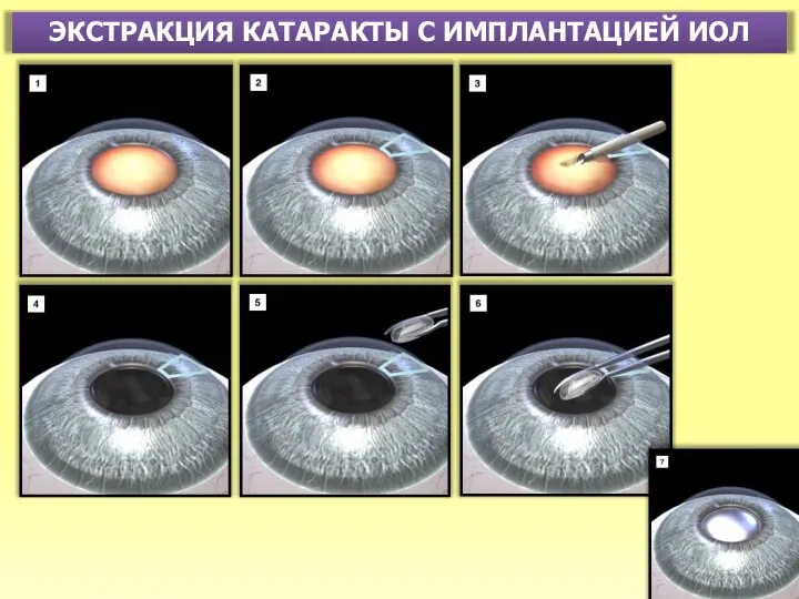 ЭКСТРАКЦИЯ КАТАРАКТЫ С ИМПЛАНТАЦИЕЙ ИОЛ