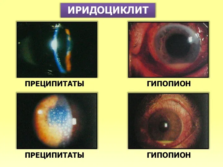 ИРИДОЦИКЛИТ ПРЕЦИПИТАТЫ ПРЕЦИПИТАТЫ ГИПОПИОН ГИПОПИОН