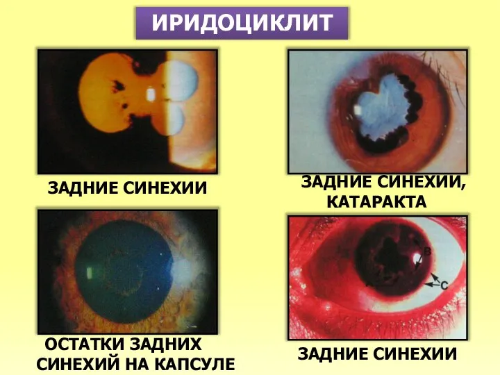 ИРИДОЦИКЛИТ ЗАДНИЕ СИНЕХИИ ЗАДНИЕ СИНЕХИИ ЗАДНИЕ СИНЕХИИ, КАТАРАКТА ОСТАТКИ ЗАДНИХ СИНЕХИЙ НА КАПСУЛЕ