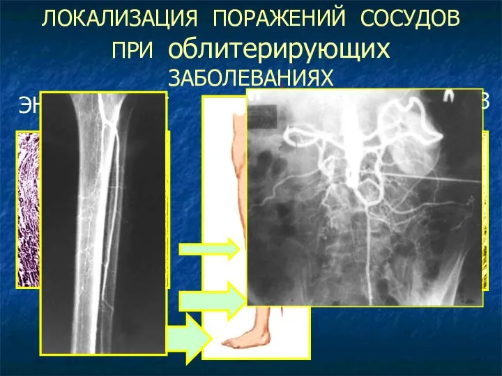 ЛОКАЛИЗАЦИЯ ПОРАЖЕНИЙ СОСУДОВ ПРИ облитерирующих ЗАБОЛЕВАНИЯХ АТЕРОСКЛЕРОЗ ЭНДАРТЕРИИТ