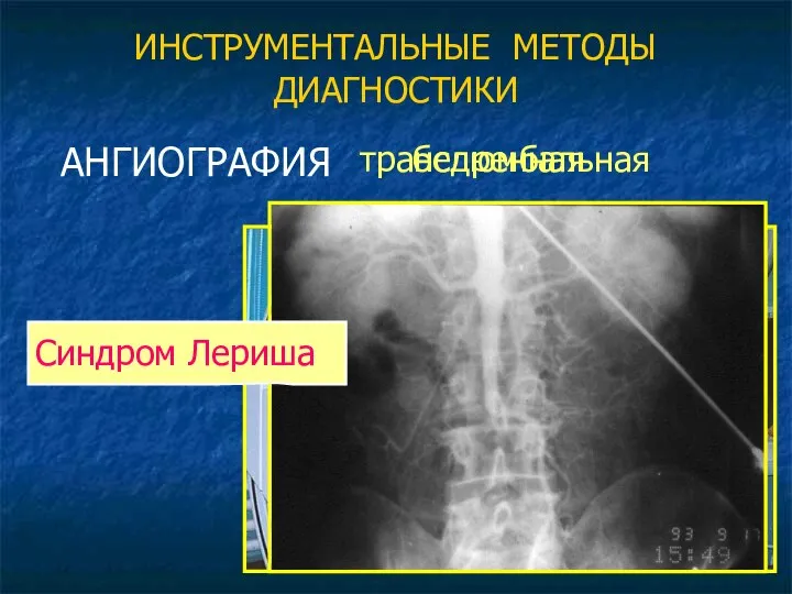 ИНСТРУМЕНТАЛЬНЫЕ МЕТОДЫ ДИАГНОСТИКИ АНГИОГРАФИЯ бедренная транслюмбальная Синдром Лериша