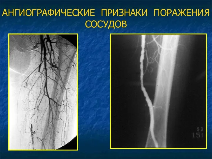 АНГИОГРАФИЧЕСКИЕ ПРИЗНАКИ ПОРАЖЕНИЯ СОСУДОВ