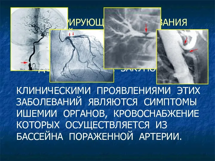 ОБЛИТЕРИРУЮЩИЕ ЗАБОЛЕВАНИЯ АРТЕРИЙ - ЭТО ЗАБОЛЕВАНИЯ, СОПРОВОЖДАЮЩИЕСЯ ПОСТЕПЕННЫМ СУЖЕНИЕМ ПРОСВЕТА АРТЕРИЙ