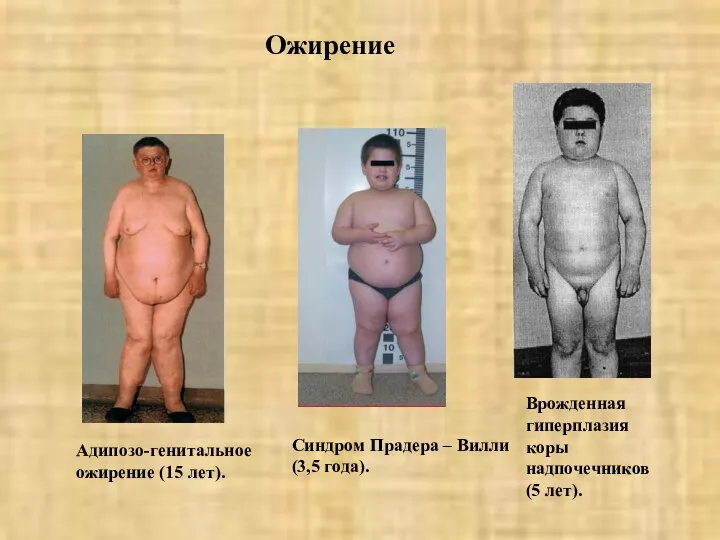 Ожирение Адипозо-генитальное ожирение (15 лет). Синдром Прадера – Вилли (3,5 года).