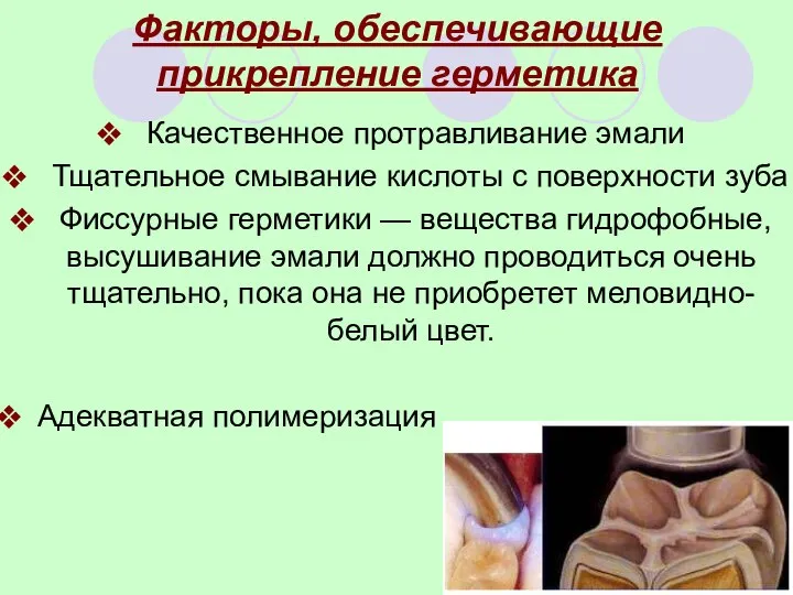 Факторы, обеспечивающие прикрепление герметика Качественное протравливание эмали Тщательное смывание кислоты с