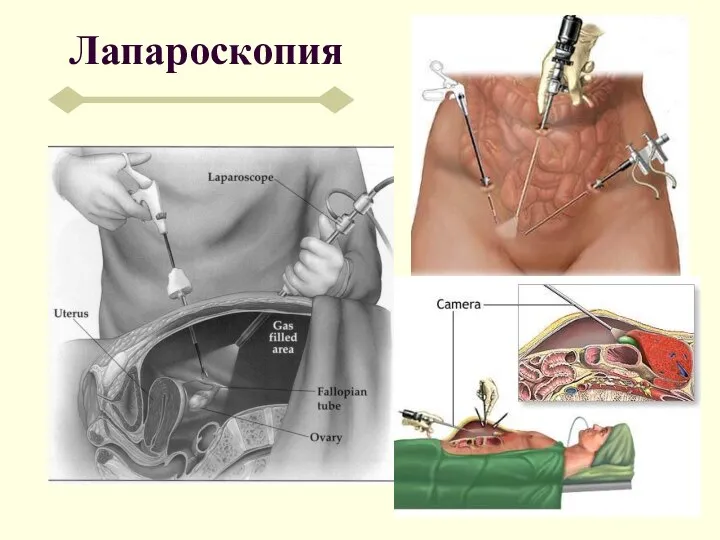 Лапароскопия