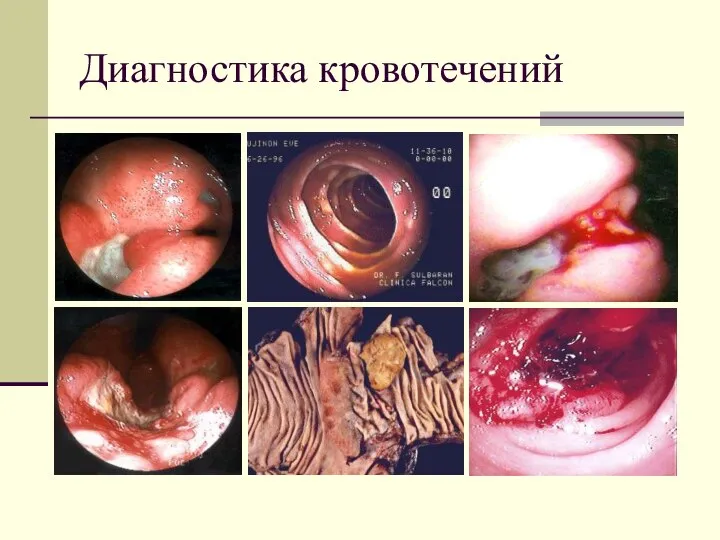 Диагностика кровотечений