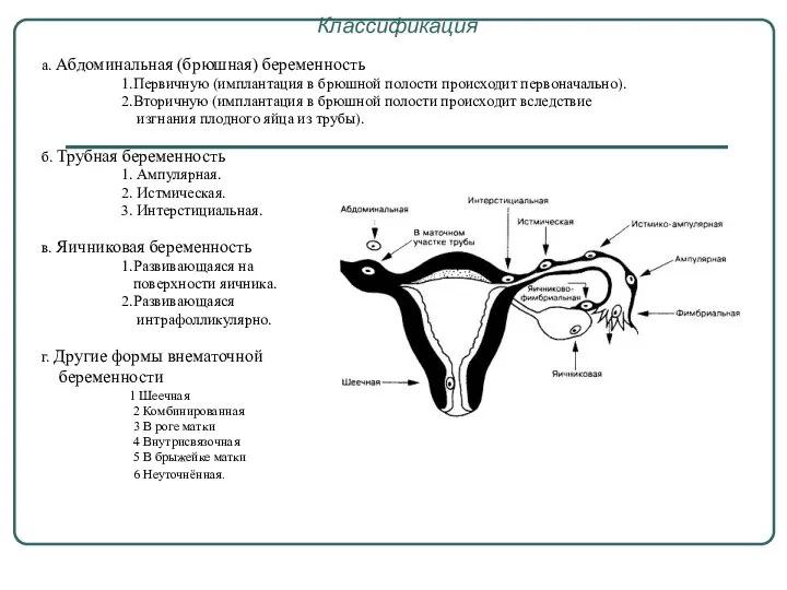 Классификация а. Абдоминальная (брюшная) беременность 1.Первичную (имплантация в брюшной полости происходит