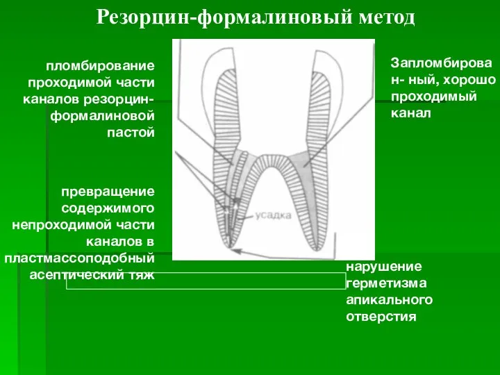 Запломбирован- ный, хорошо проходимый канал нарушение герметизма апикального отверстия пломбирование проходимой