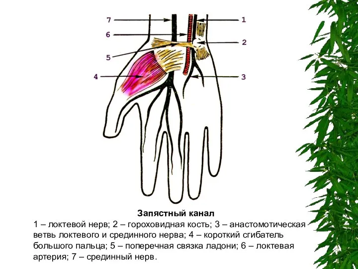 Запястный канал 1 – локтевой нерв; 2 – гороховидная кость; 3