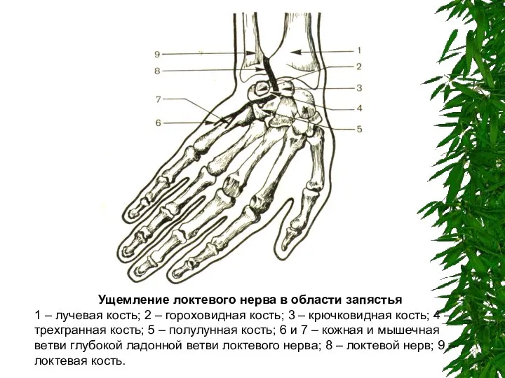 Ущемление локтевого нерва в области запястья 1 – лучевая кость; 2