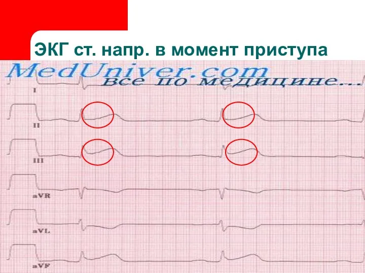 ЭКГ ст. напр. в момент приступа