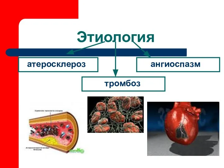 Этиология атеросклероз ангиоспазм тромбоз