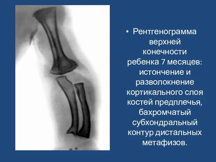 Рентгенограмма верхней конечности ребенка 7 месяцев: истончение и разволокнение кортикального слоя