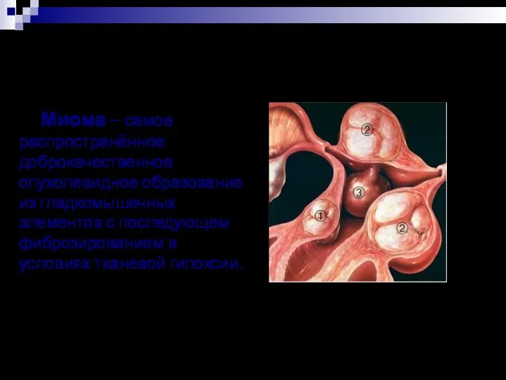 Миома – самое распространённое доброкачественное опухолевидное образование из гладкомышечных элементов с