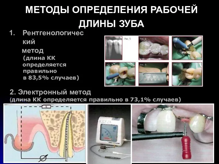 МЕТОДЫ ОПРЕДЕЛЕНИЯ РАБОЧЕЙ ДЛИНЫ ЗУБА 2. Электронный метод (длина КК определяется