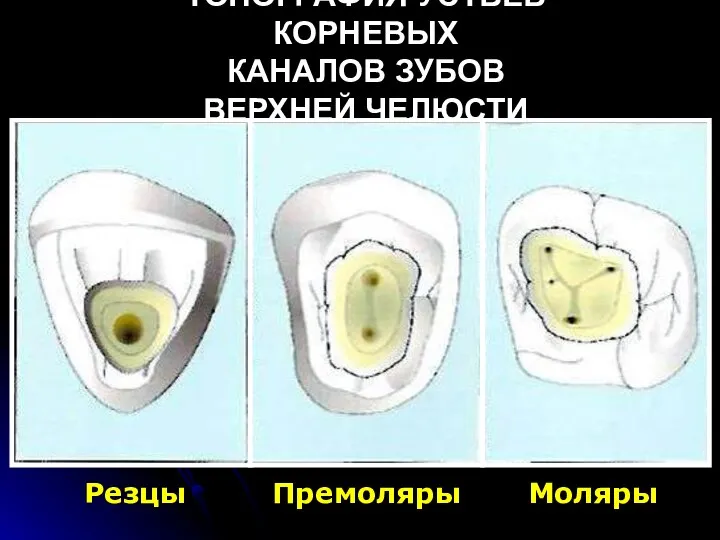 Резцы Премоляры Моляры ТОПОГРАФИЯ УСТЬЕВ КОРНЕВЫХ КАНАЛОВ ЗУБОВ ВЕРХНЕЙ ЧЕЛЮСТИ