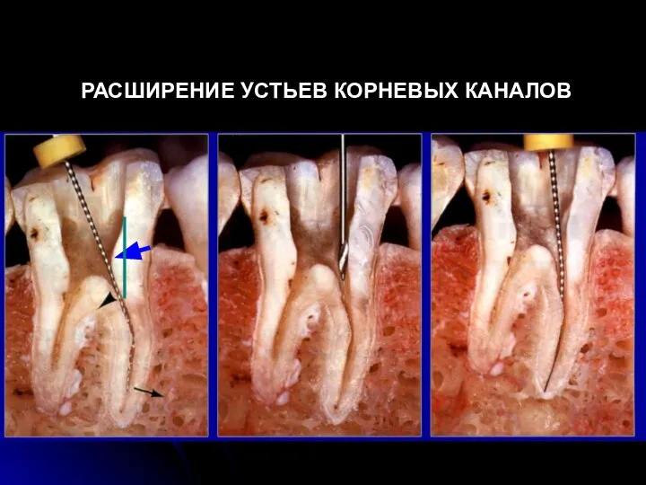 РАСШИРЕНИЕ УСТЬЕВ КОРНЕВЫХ КАНАЛОВ