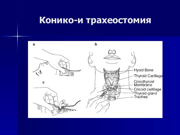 Конико-и трахеостомия