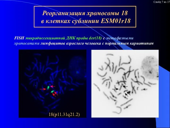 Результаты гибридизации микродисс пробы r18 на нормальные хромосомы FISH микродиссекционной ДНК