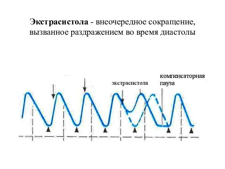 Экстрасистола - внеочередное сокращение, вызванное раздражением во время диастолы