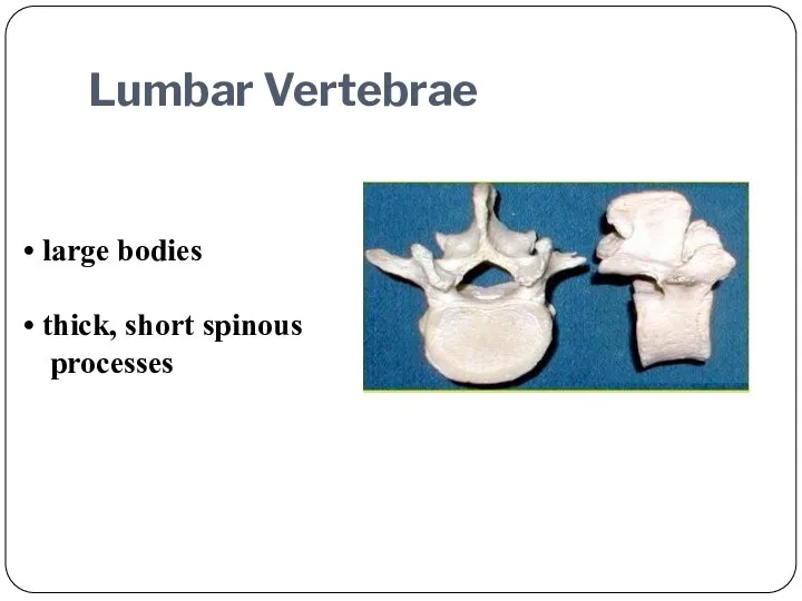 large bodies thick, short spinous processes Lumbar Vertebrae