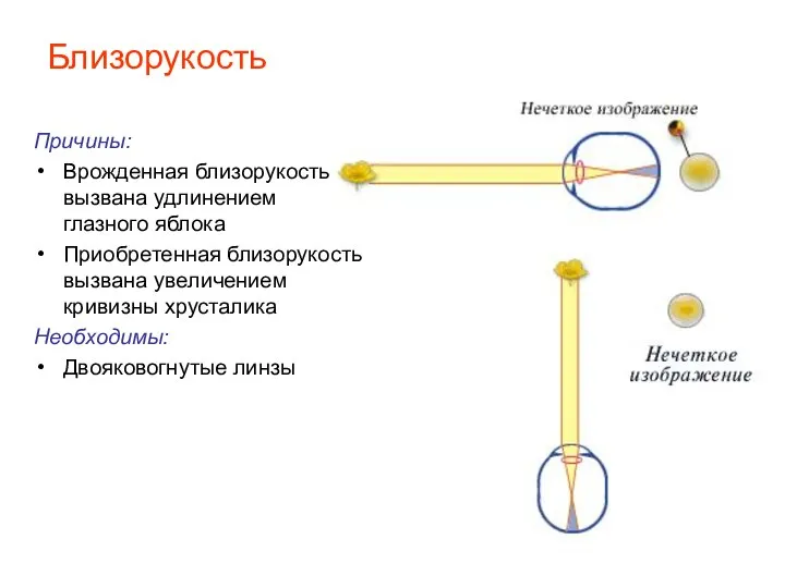 Близорукость Причины: Врожденная близорукость вызвана удлинением глазного яблока Приобретенная близорукость вызвана