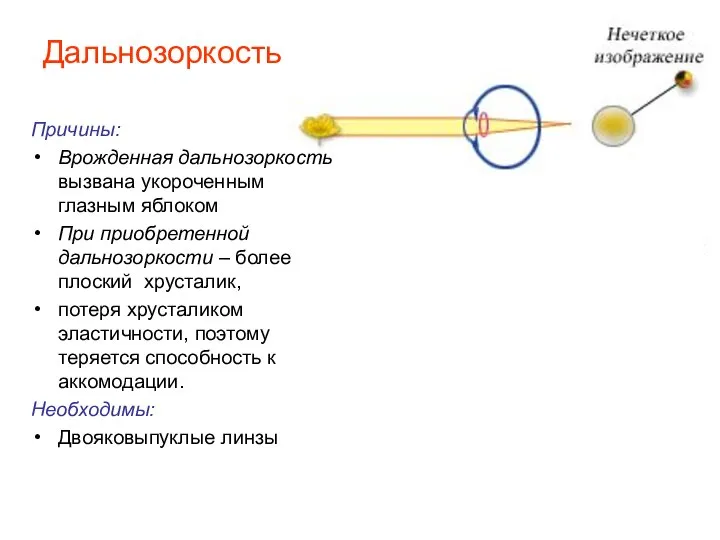 Дальнозоркость Причины: Врожденная дальнозоркость вызвана укороченным глазным яблоком При приобретенной дальнозоркости