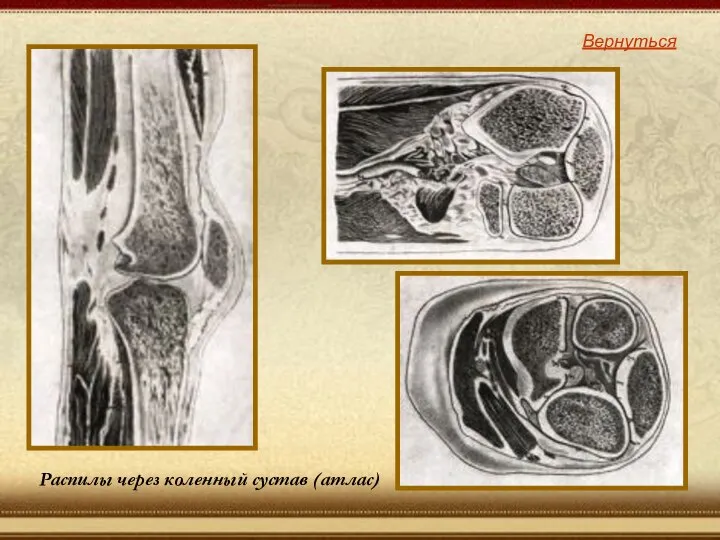 Распилы через коленный сустав (атлас) Вернуться