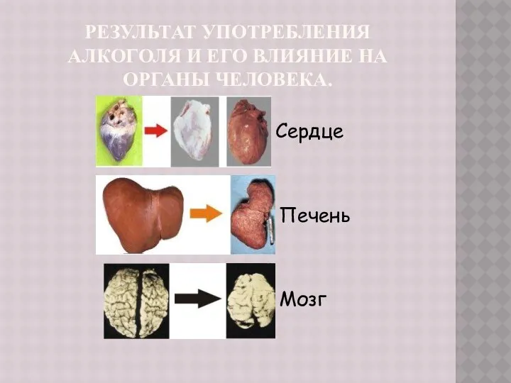 Результат употребления алкоголя и его влияние на органы человека. Сердце Печень Мозг