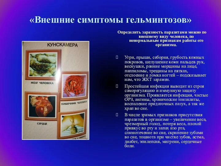 «Внешние симптомы гельминтозов» Определить заразность паразитами можно по внешнему виду человека,