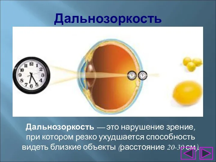 Дальнозоркость Дальнозоркость — это нарушение зрение, при котором резко ухудшается способность