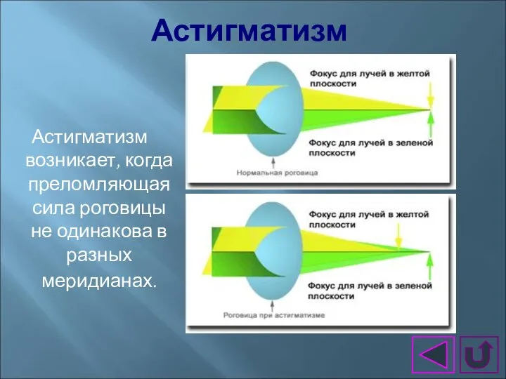 Астигматизм Астигматизм возникает, когда преломляющая сила роговицы не одинакова в разных меридианах.