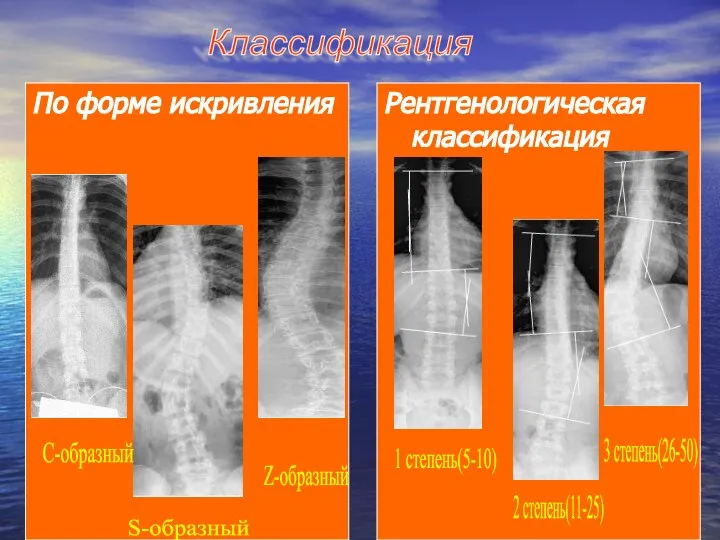 По форме искривления Рентгенологическая классификация С-образный S-образный Z-образный 1 степень(5-10) 2 степень(11-25) 3 степень(26-50) Классификация