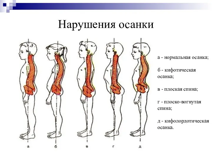 Нарушения осанки а - нормальная осанка; б - кифотическая осанка; в