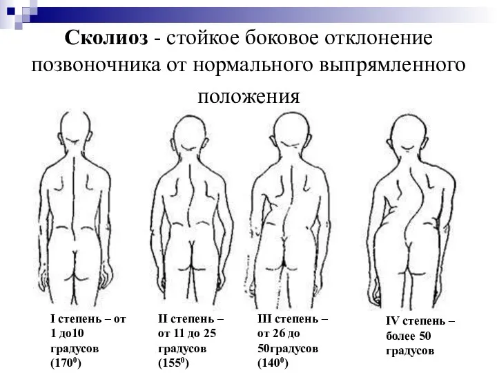 Сколиоз - стойкое боковое отклонение позвоночника от нормального выпрямленного положения I