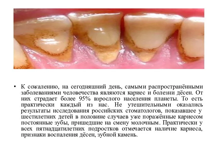 К сожалению, на сегодняшний день, самыми распространёнными заболеваниями человечества являются кариес