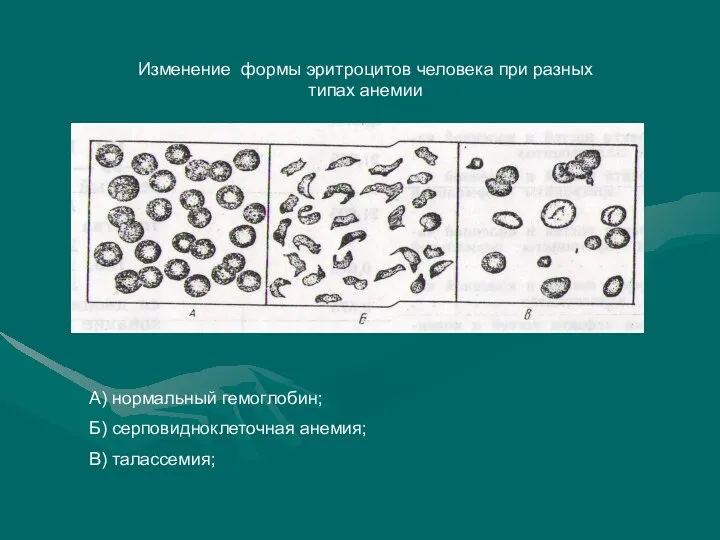 Изменение формы эритроцитов человека при разных типах анемии А) нормальный гемоглобин; Б) серповидноклеточная анемия; В) талассемия;