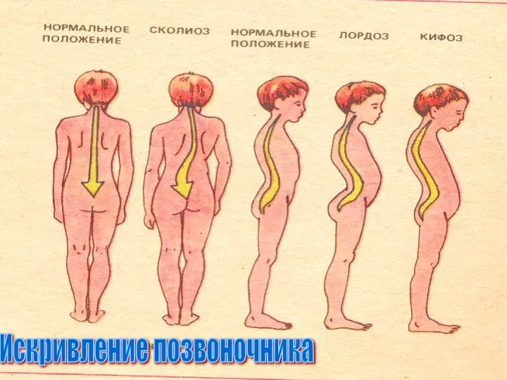 Искривление позвоночника