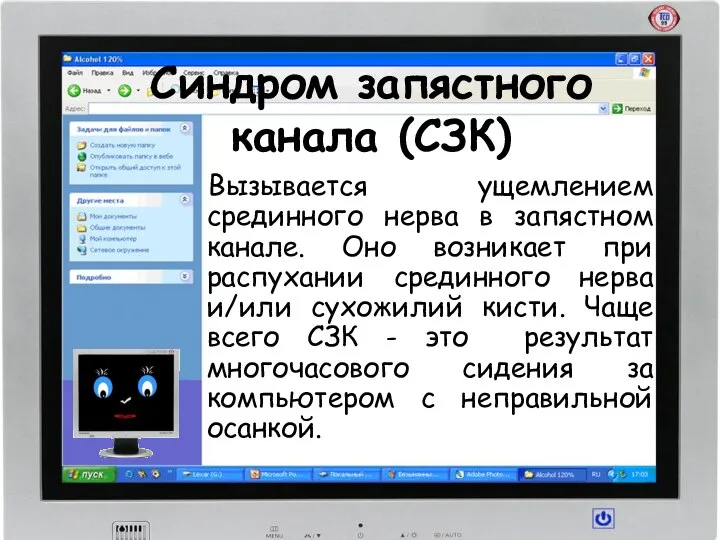 Синдром запястного канала (СЗК)‏ Вызывается ущемлением срединного нерва в запястном канале.