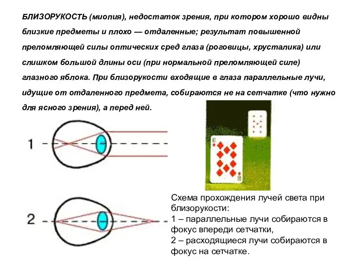 БЛИЗОРУКОСТЬ (миопия), недостаток зрения, при котором хорошо видны близкие предметы и