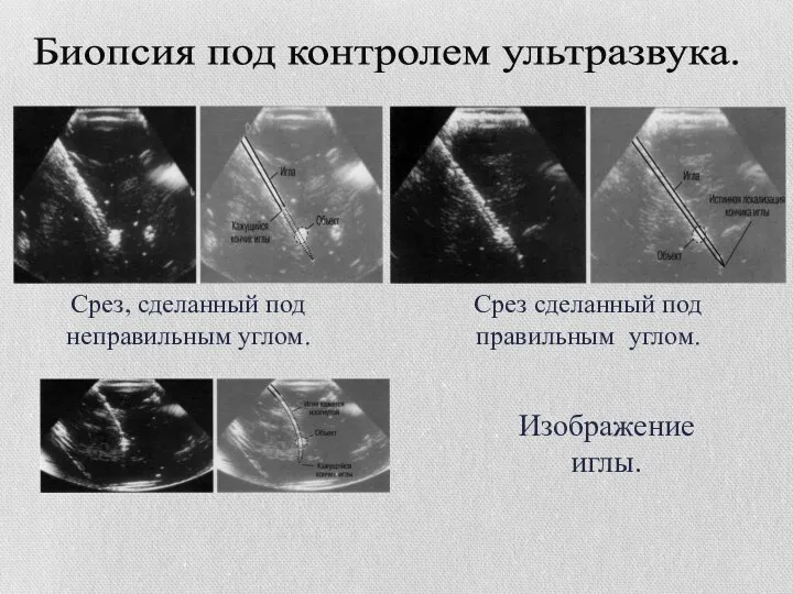 Срез, сделанный под неправильным углом. Срез сделанный под правильным углом. Изображение иглы. Биопсия под контролем ультразвука.