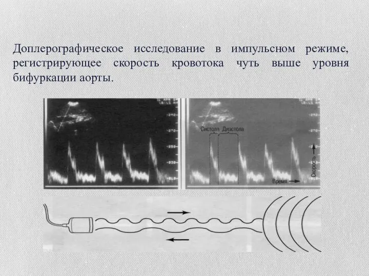 Доплерографическое исследование в импульсном режиме, регистрирующее скорость кровотока чуть выше уровня бифуркации аорты. Эффект Доплера. Доплерография.